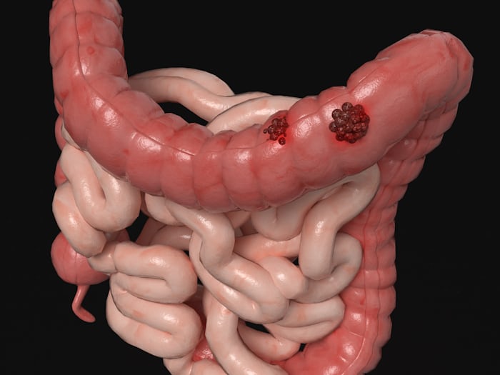 Can Ulcer Patients Eat Roasted Plantain? (What to Know)